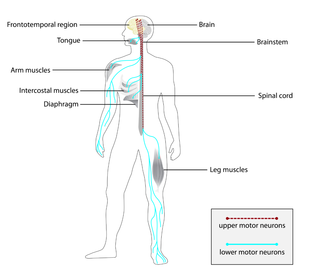SLA neuroni e muscoli affetti